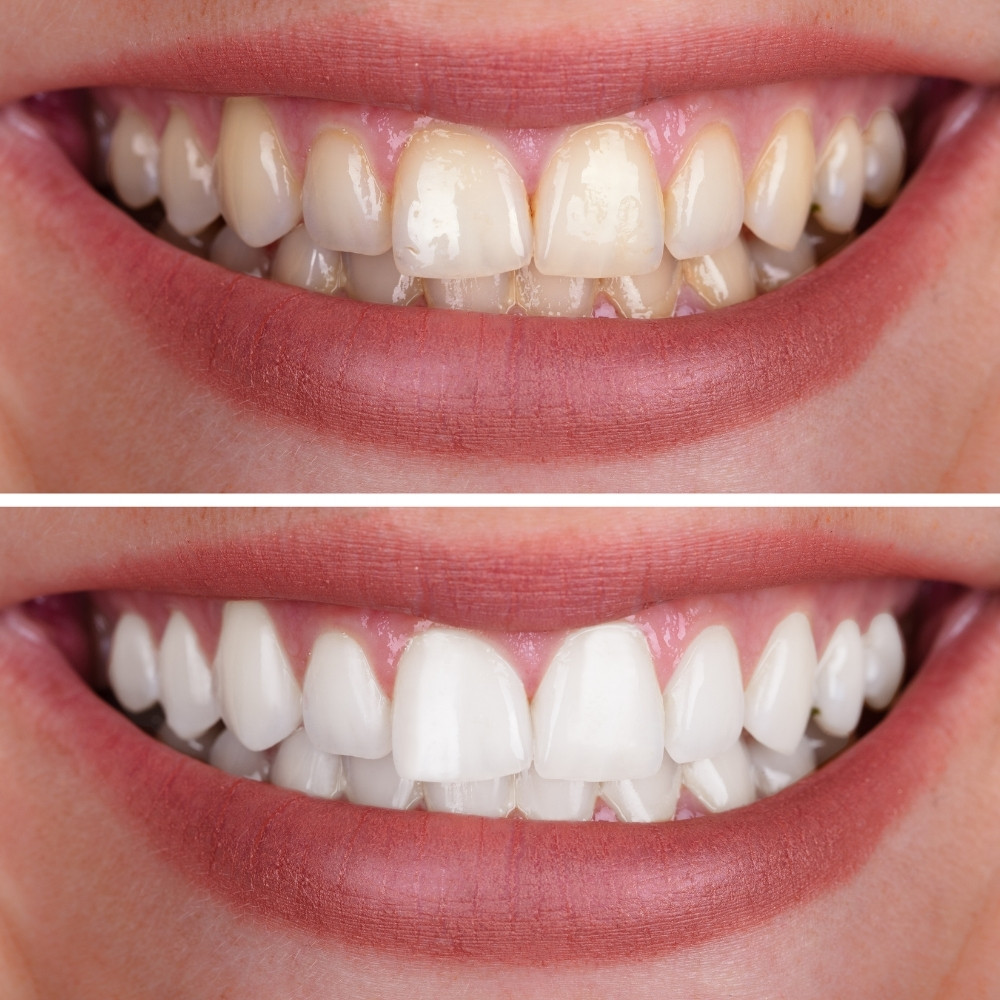 before and after pictures of patient's teeth after getting teeth whitening at Everbright Smiles Scarborough