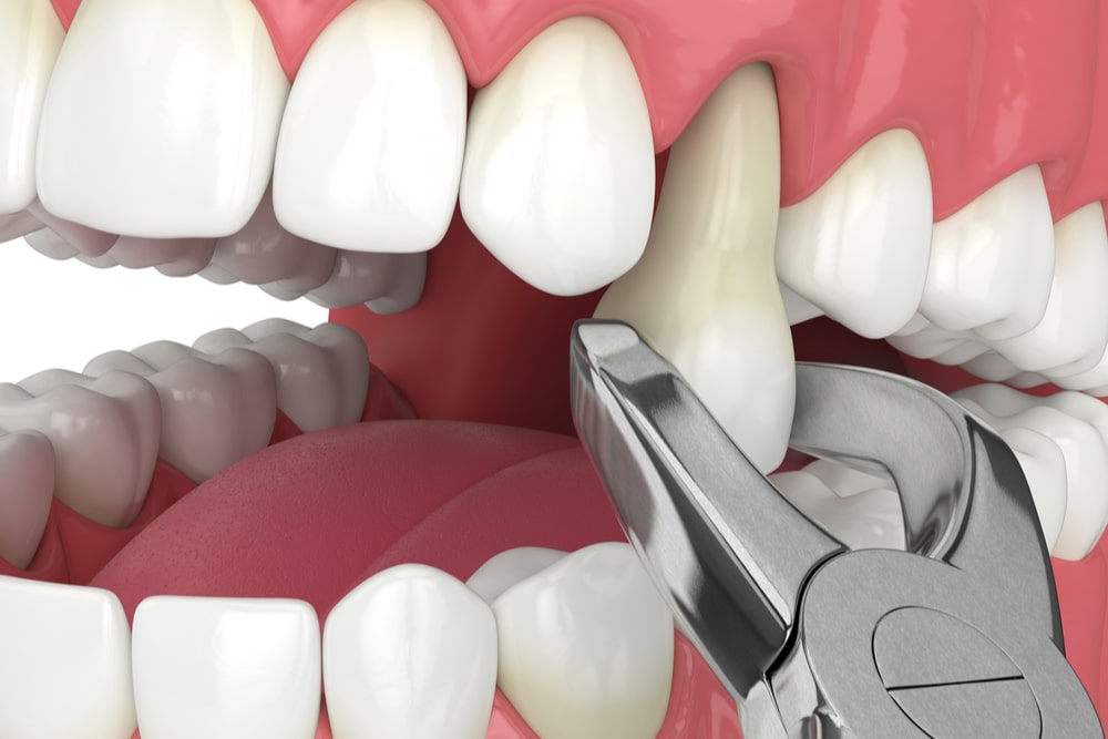 Signs You May Need to Have a Tooth Pulled