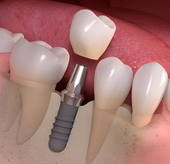 A Comprehensive Guide to the Dental Implant Process