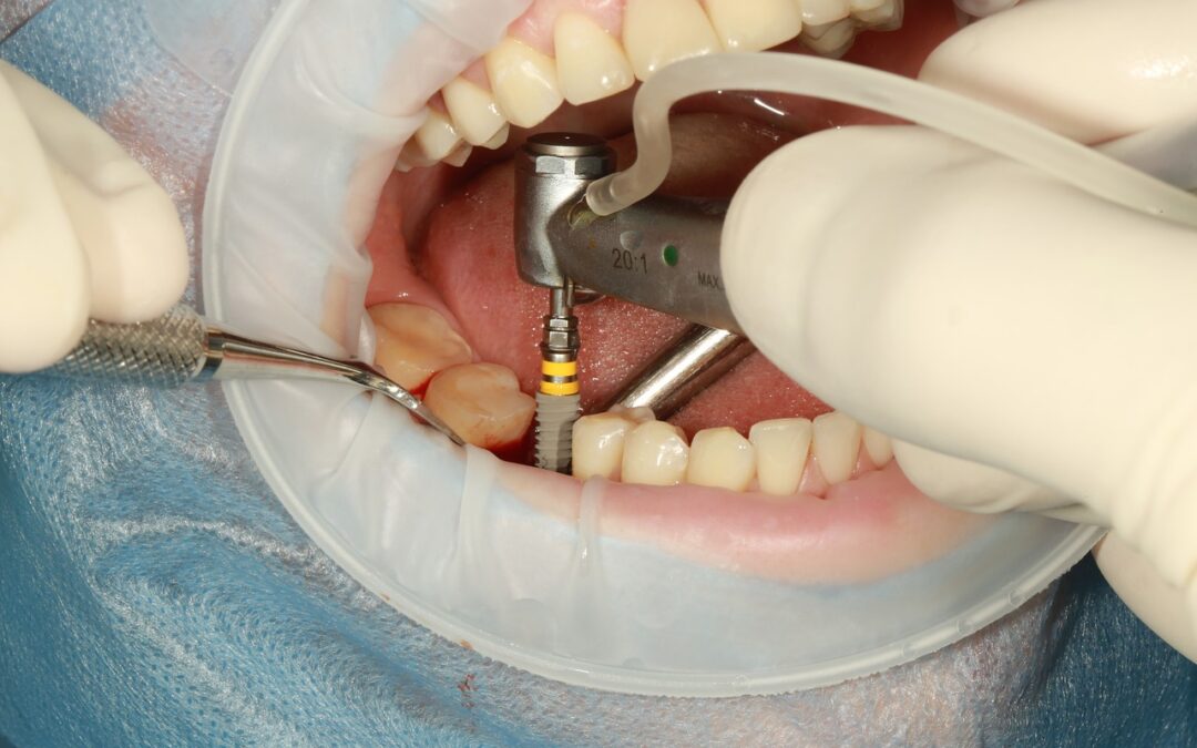 Post Operative Instructions For Dental Implants