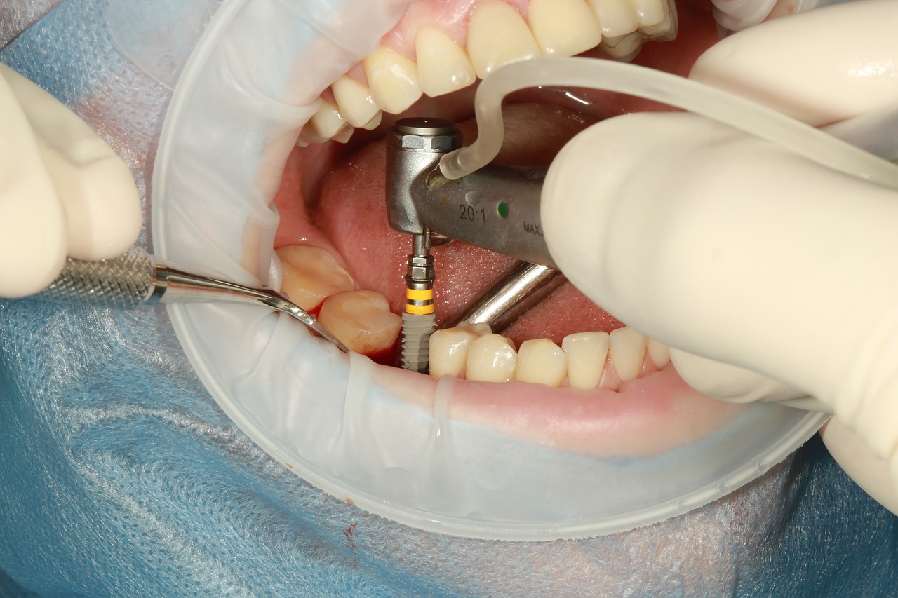 Close-up view of dentist placing implant in jawbone