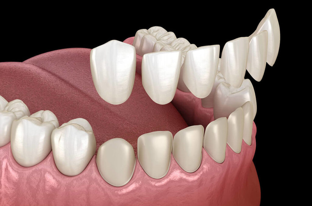 Dental Veneers: Pros And Cons